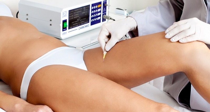 Carbossiterapia per il corpo e per il viso, ecco come funziona 